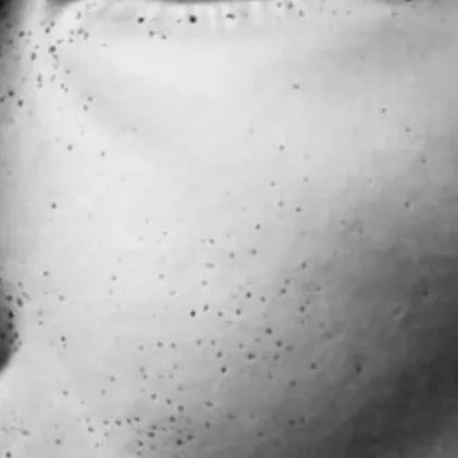 Close-up skin image after using Punctual